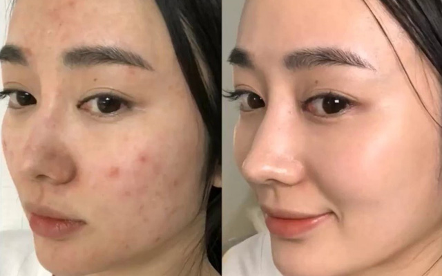 Công dụng của kem nghệ không màu trong việc trị mụn